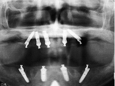 All-on-4ケース2術後レントゲン画像