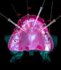 ガイディッド・サージェリー(Guided Surgery)イメージ1