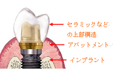 インプラントの構造