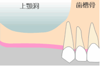 上顎洞へのアプローチ