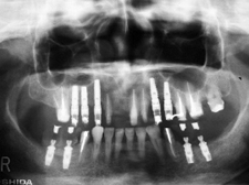即時負荷インプラント治療例ケース2術後レントゲン写真
